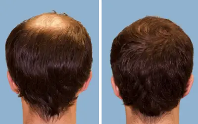 Before and After